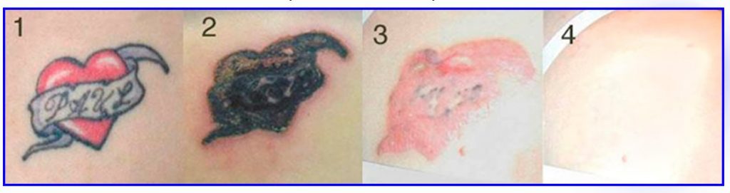 Ejemplo de proceso de borrado de tatuajes con Rejuvi